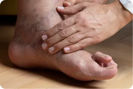 Atención a heridas crónicas